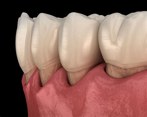periodontal disease summerlin nv